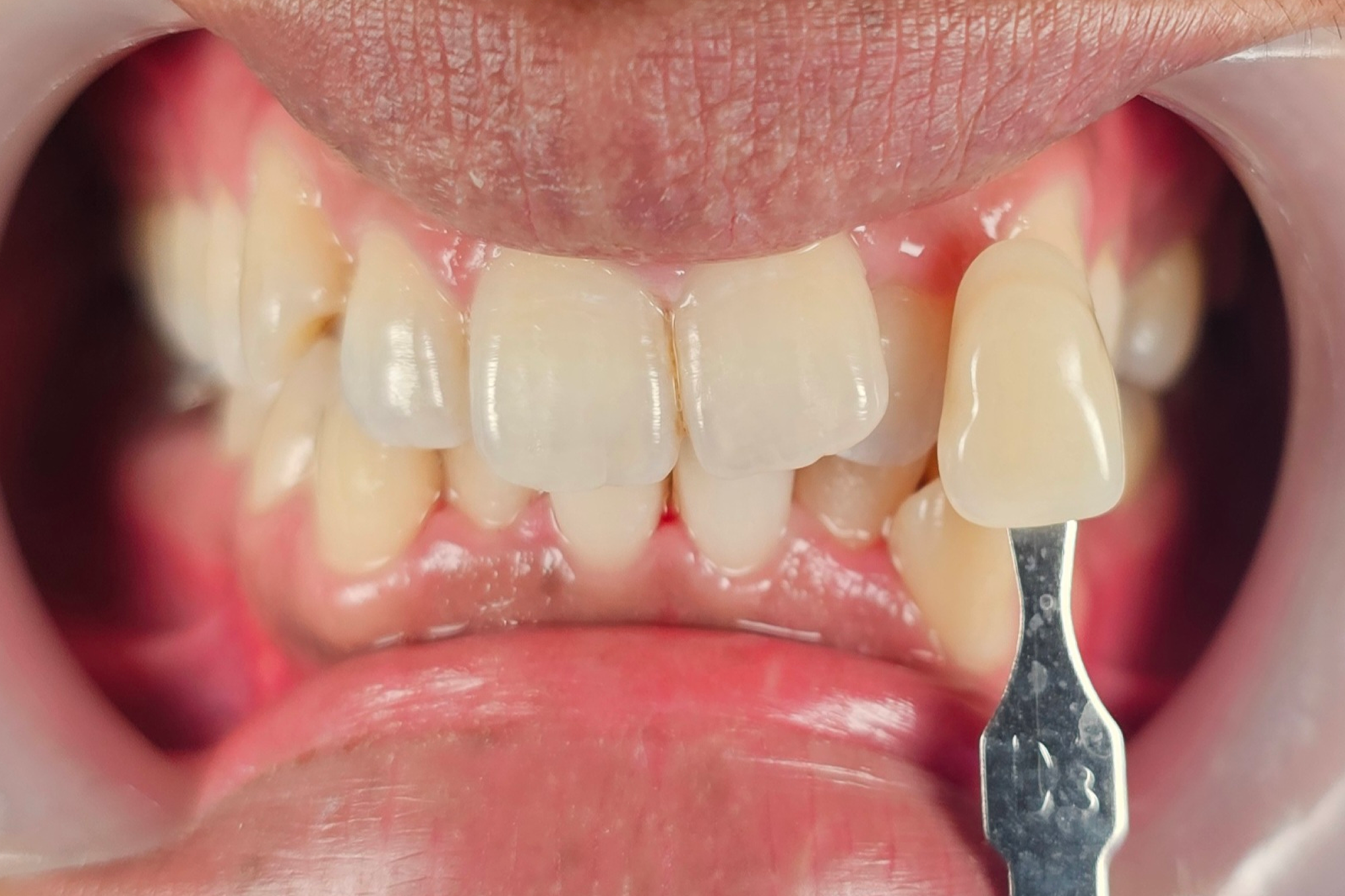 Bleaching Before Bleaching Before