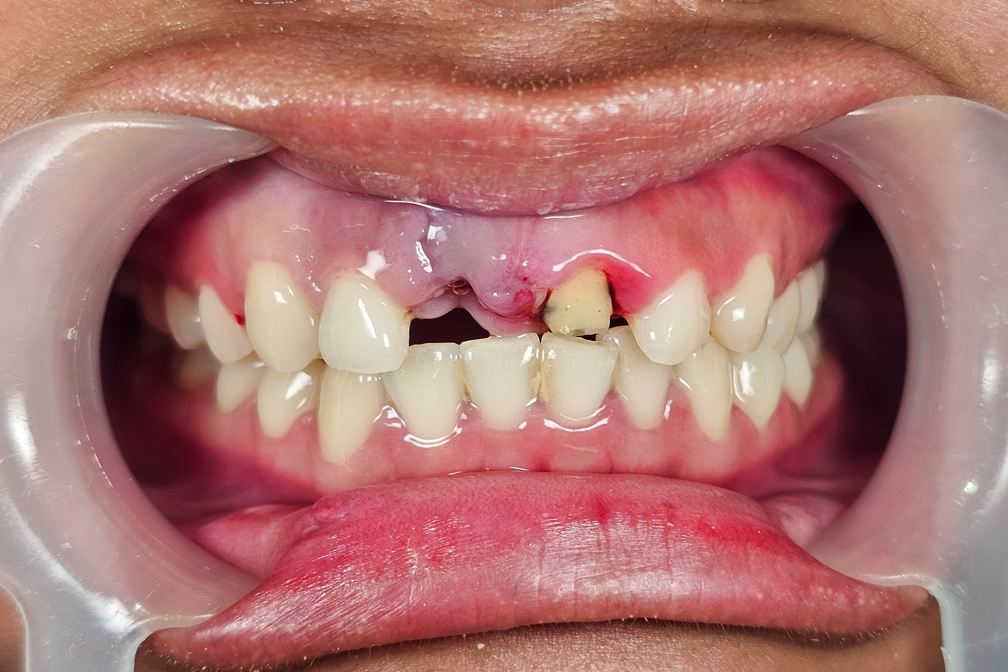 Bridge Before Bridge Before