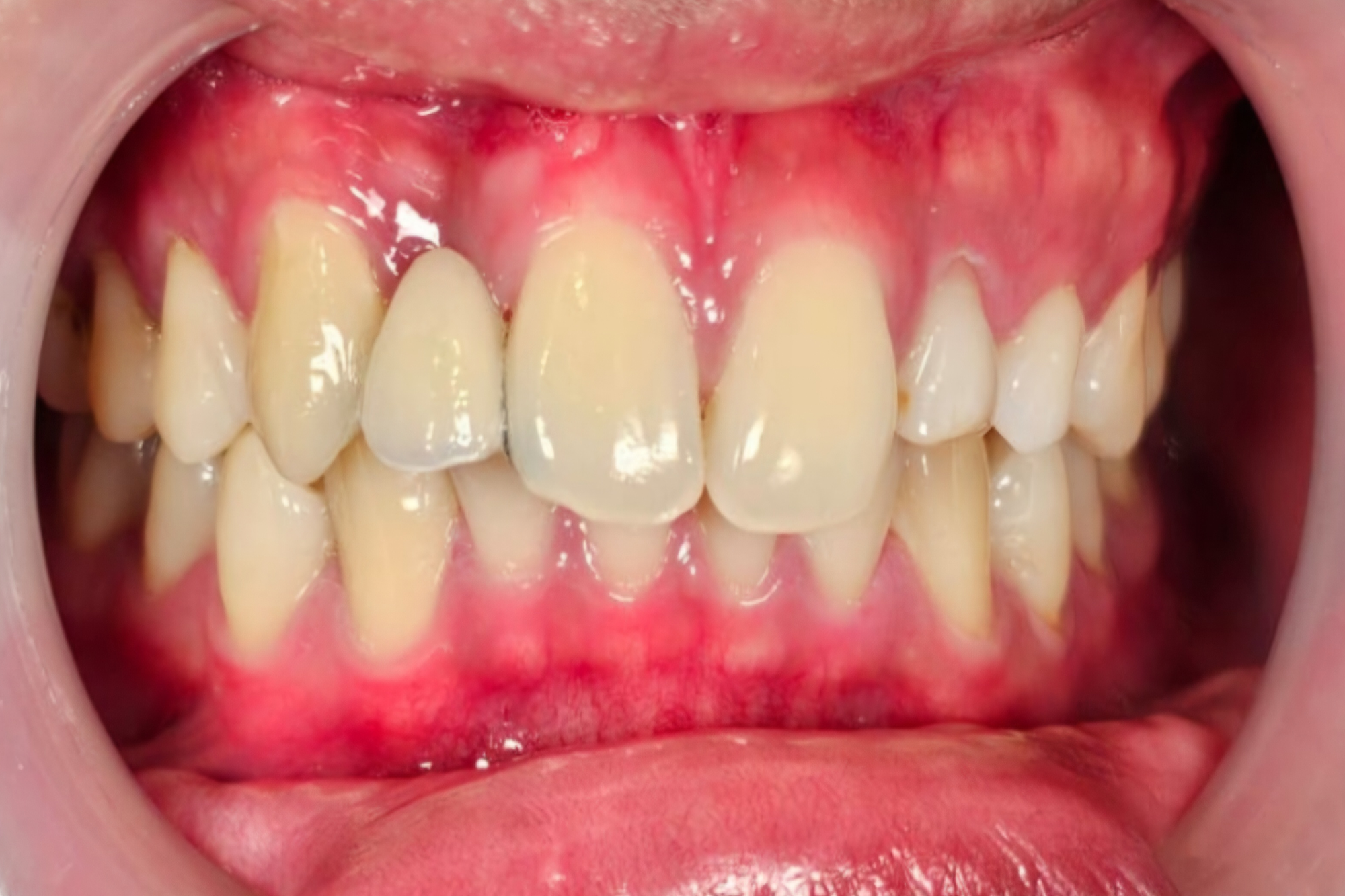 Maryland Bridge After