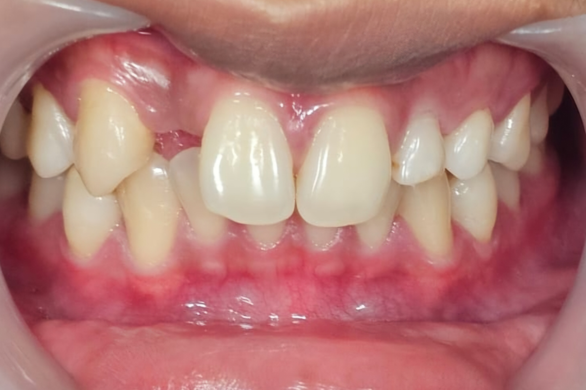 Maryland Bridge Before Maryland Bridge Before